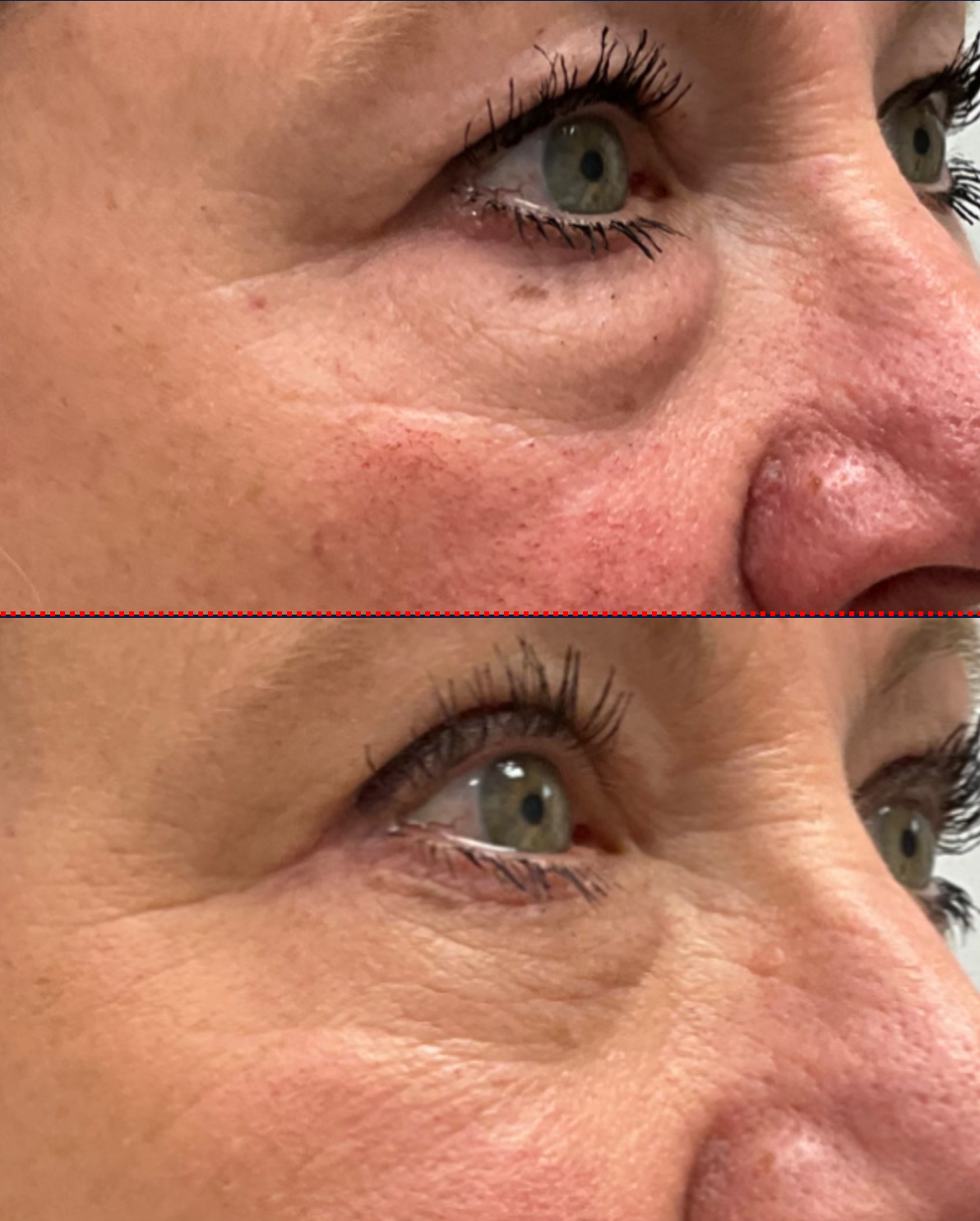 Case--6588 | Before and After Blepharoplasty 2