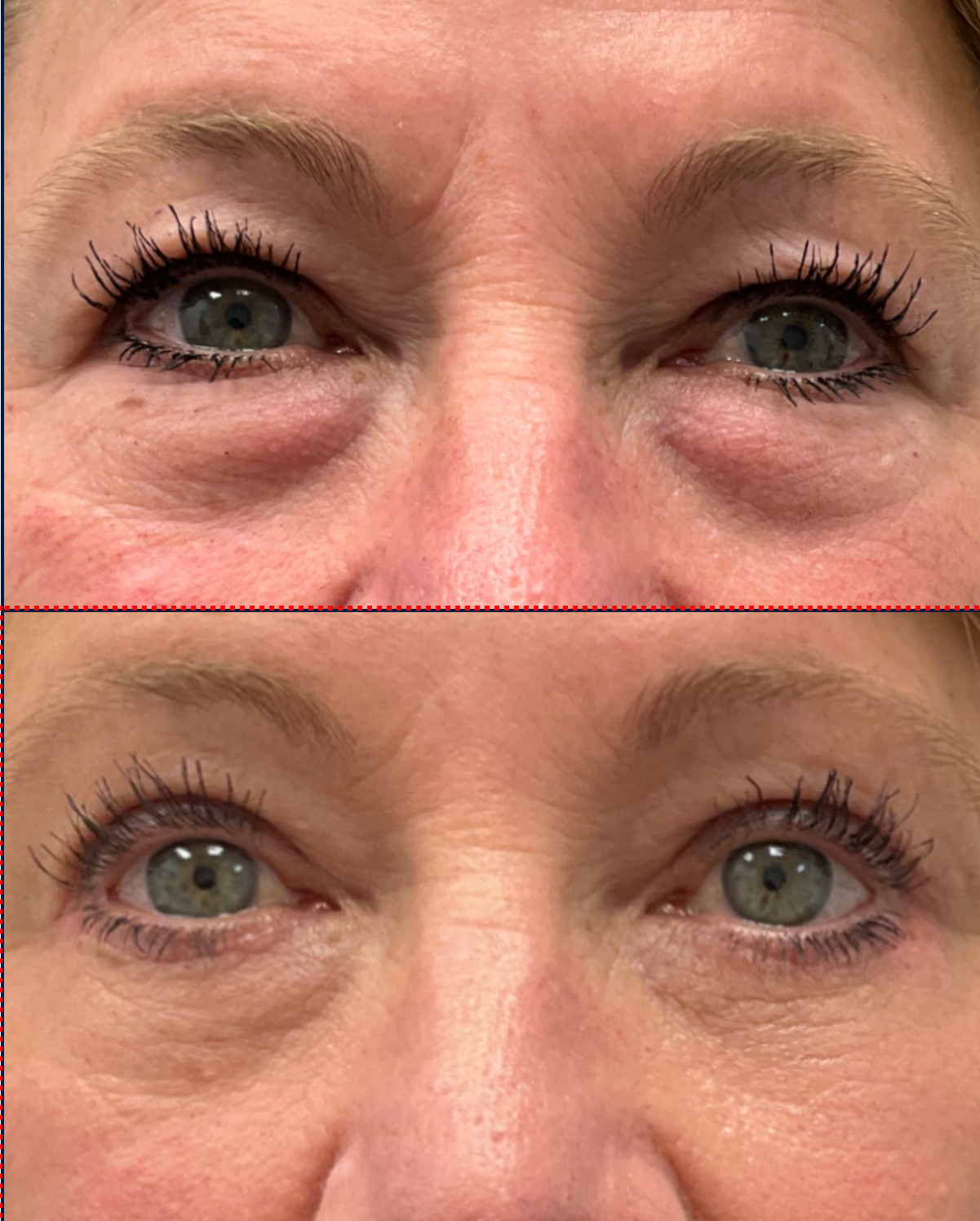 Case--6588 | Before and After Blepharoplasty