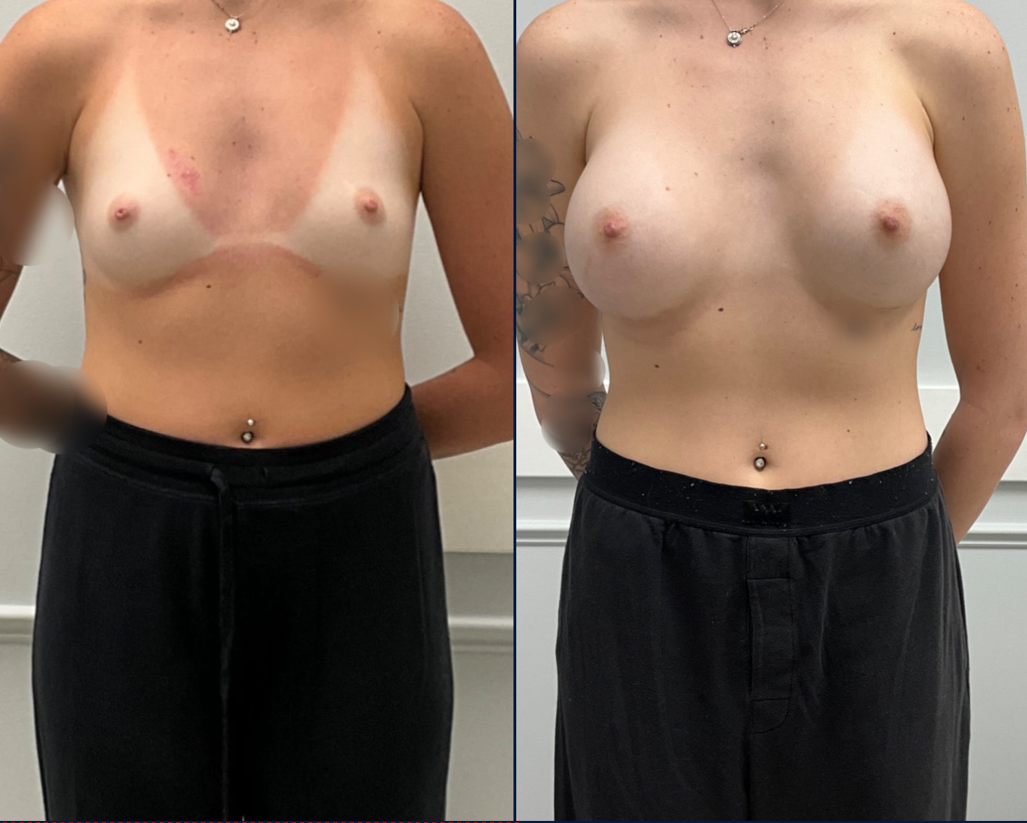 Case--5101 | Before and After Breast Augmentation