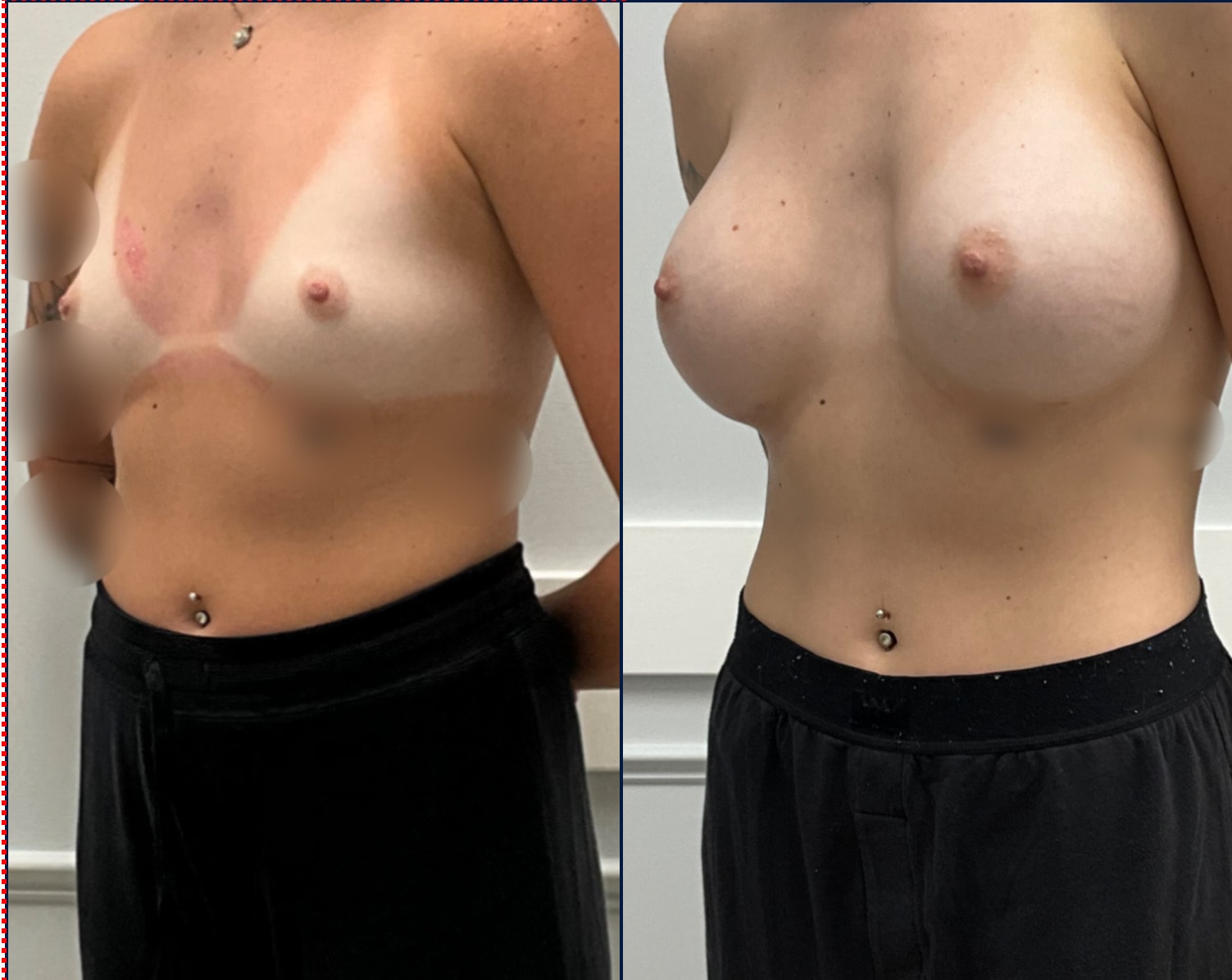 Case--5101 | Before and After Breast Augmentation 2