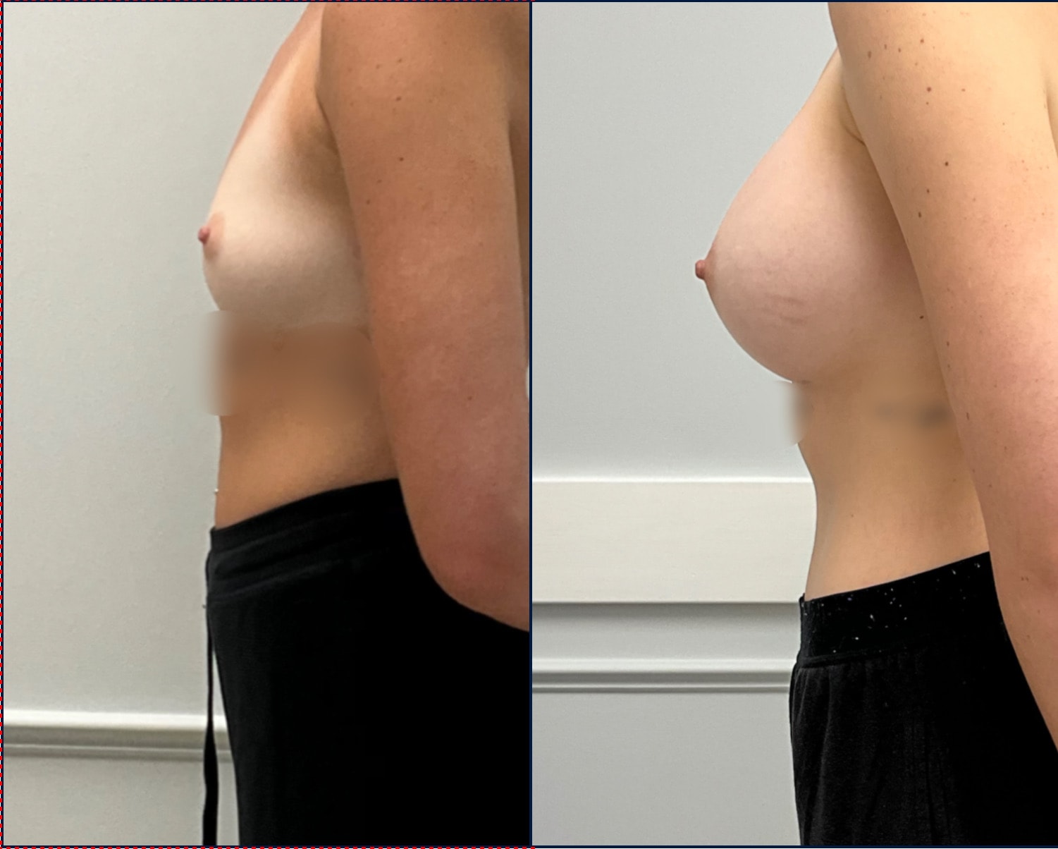 Case--5101 | Before and After Breast Augmentation 3