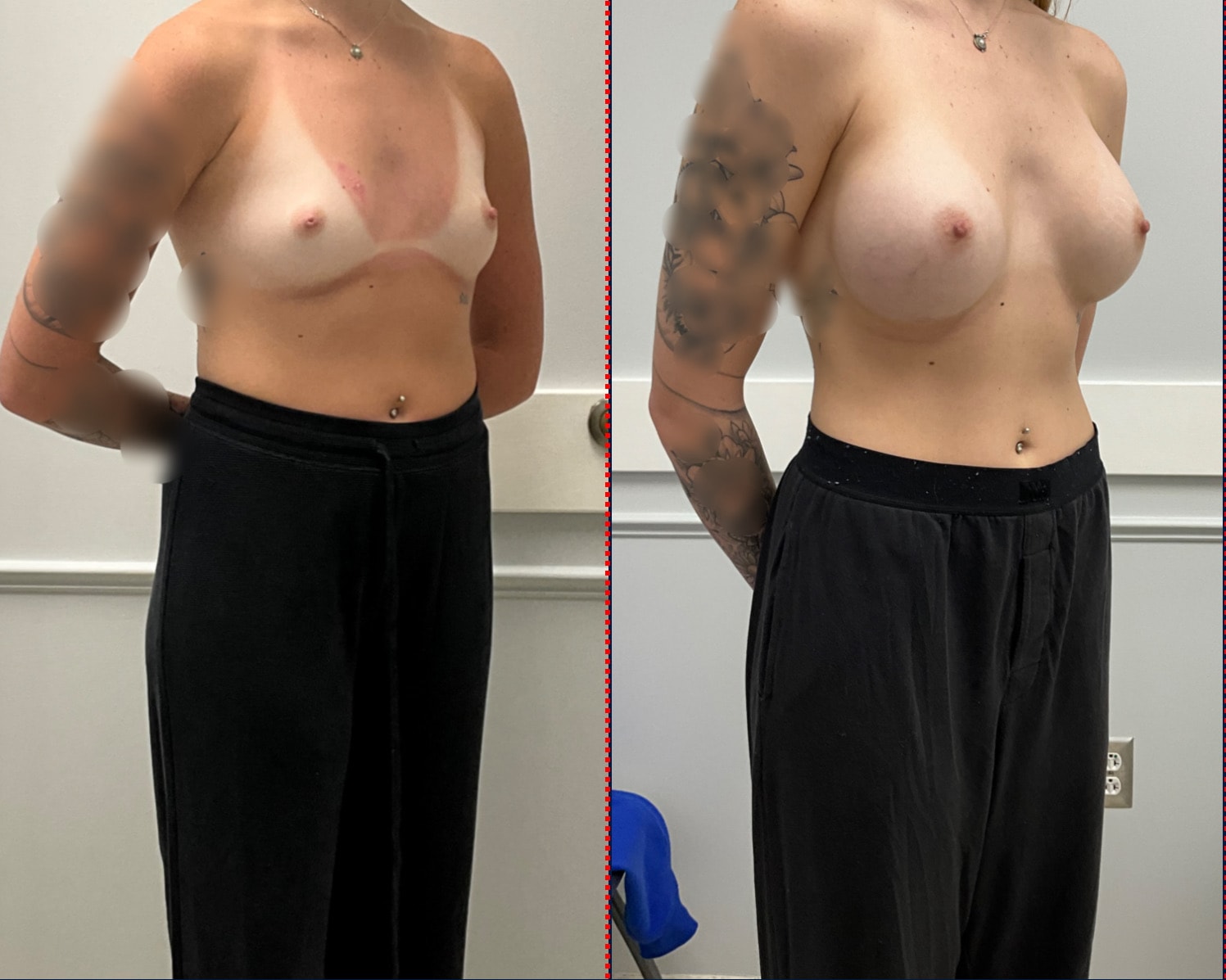 Case--5101 | Before and After Breast Augmentation 4